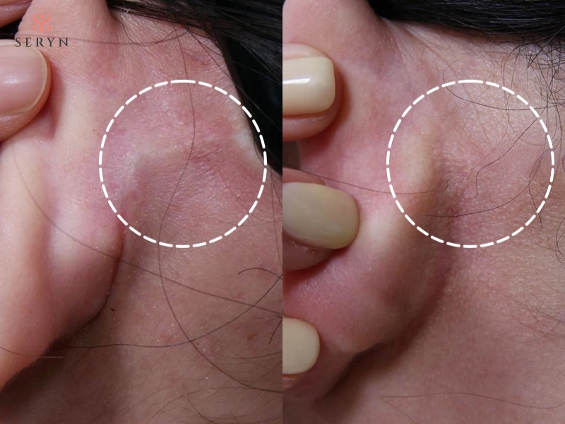 Phần da dư được loại bỏ trước khi khâu đóng đường mổ tại các vị trí ít lộ sẹo Phần da dư được loại bỏ trước khi khâu đóng đường mổ tại các vị trí ít lộ sẹo
