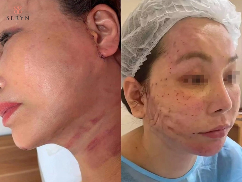Facelift có thể gây sưng, bầm, nhiễm trùng, tụ máu hoặc các biến chứng liên quan đến phẫu thuật Facelift có thể gây sưng, bầm, nhiễm trùng, tụ máu hoặc các biến chứng liên quan đến phẫu thuật