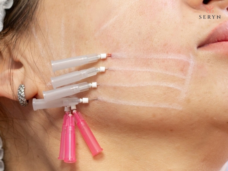 Chỉ PDO phân hủy dần và kích thích nguyên bào sợi sản sinh collagen tại vùng điều trị Chỉ PDO phân hủy dần và kích thích nguyên bào sợi sản sinh collagen tại vùng điều trị