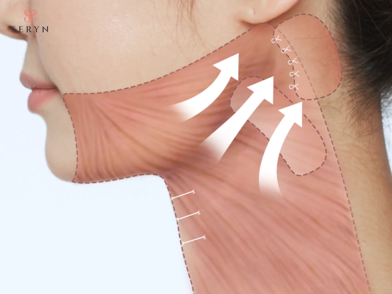 Phẫu thuật căng da tác động sâu vào mô nâng đỡ và loại bỏ phần da dư thừa Phẫu thuật căng da tác động sâu vào mô nâng đỡ và loại bỏ phần da dư thừa