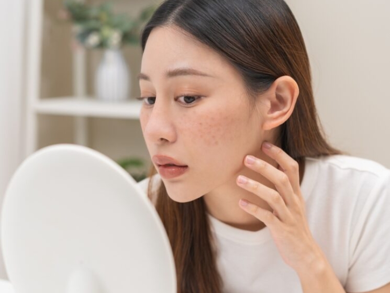 Nám mảng và nếp nhăn động bắt đầu rõ hơn ở độ tuổi 30-40 Nám mảng và nếp nhăn động bắt đầu rõ hơn ở độ tuổi 30-40