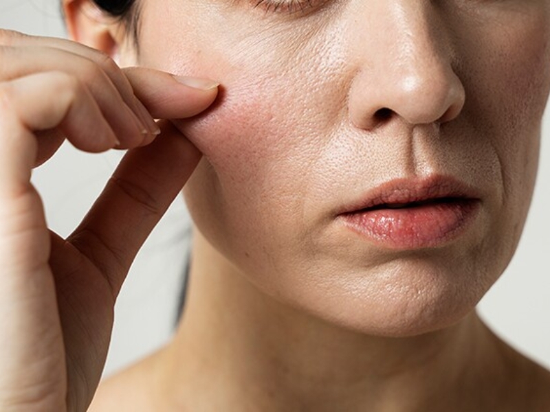 Da mất đàn hồi khi collagen và elastin suy giảm, khiến mô da khó trở về trạng thái ban đầu Da mất đàn hồi khi collagen và elastin suy giảm, khiến mô da khó trở về trạng thái ban đầu