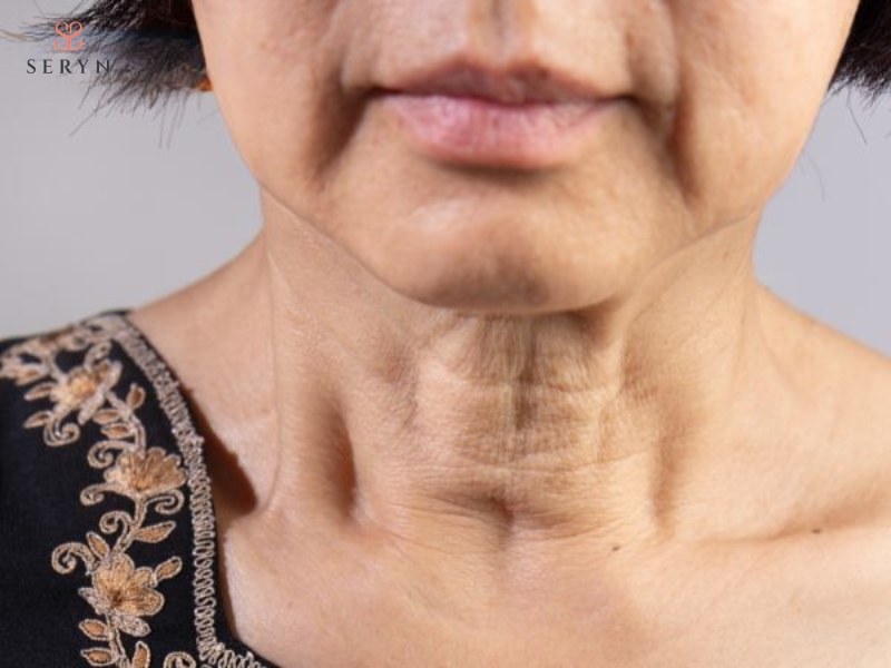 Da chảy xệ rõ, xuất hiện jowl và có thể kèm theo nếp gấp vùng cằm, cổ Da chảy xệ rõ, xuất hiện jowl và có thể kèm theo nếp gấp vùng cằm, cổ