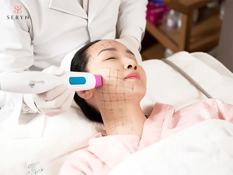 Thermage sử dụng sóng RF đơn cực tạo nhiệt trong mô da, hỗ trợ co rút collagen và kích thích tái tạo collagen mới Thermage sử dụng sóng RF đơn cực tạo nhiệt trong mô da, hỗ trợ co rút collagen và kích thích tái tạo collagen mới