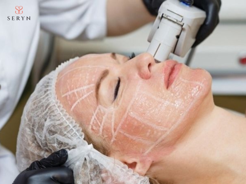 HIFU thường được cân nhắc là lựa chọn chính cho nhóm trên 45 tuổi HIFU thường được cân nhắc là lựa chọn chính cho nhóm trên 45 tuổi