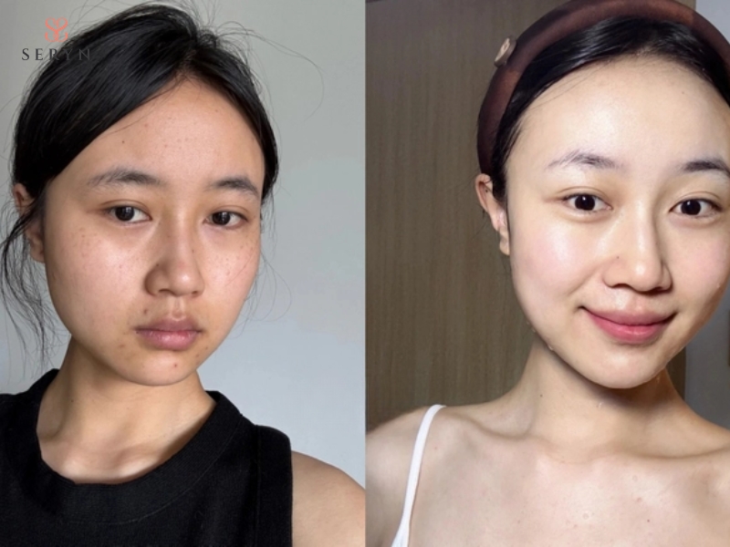 Thermage có thể được cân nhắc cho làn da kém săn chắc, kết cấu không đều Thermage có thể được cân nhắc cho làn da kém săn chắc, kết cấu không đều