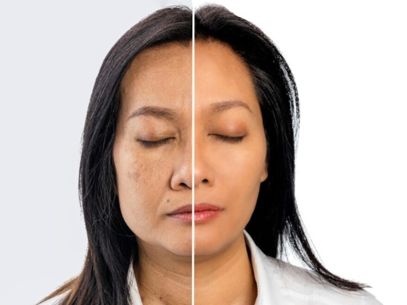 Lão hóa da vùng má thường biểu hiện qua mất thể tích và chảy xệ mô mềm Lão hóa da vùng má thường biểu hiện qua mất thể tích và chảy xệ mô mềm