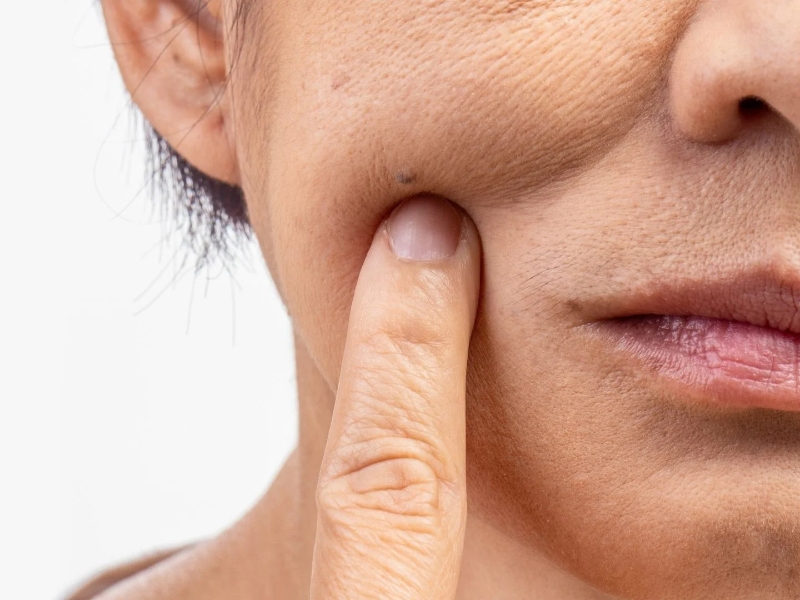 Lão hóa da mặt theo vùng chịu ảnh hưởng bởi cấu trúc da và quá trình suy giảm collagen, elastin Lão hóa da mặt theo vùng chịu ảnh hưởng bởi cấu trúc da và quá trình suy giảm collagen, elastin