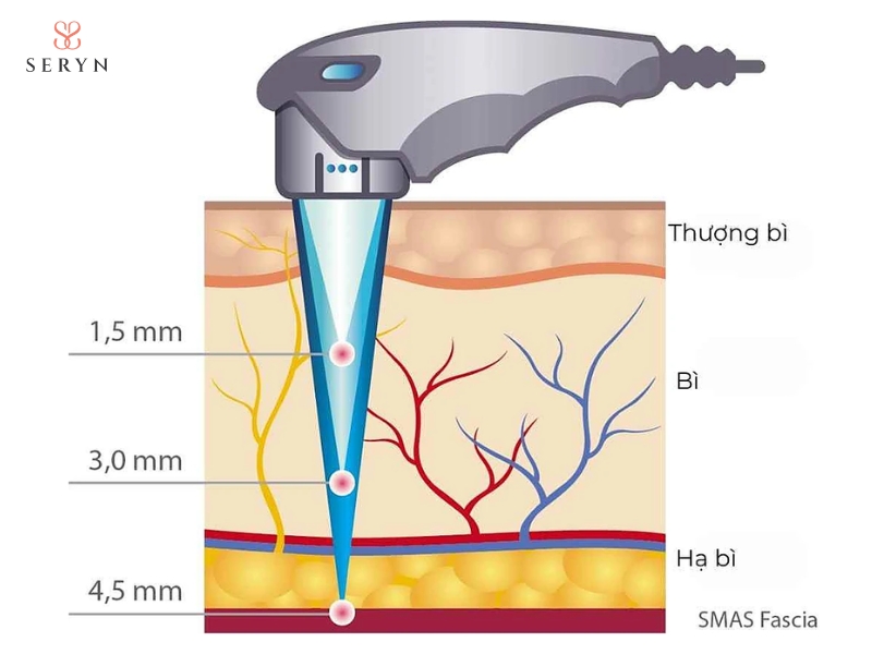 HIFU sử dụng các đầu phát với độ sâu khác nhau để tác động vào từng lớp mô theo mục tiêu điều trị HIFU sử dụng các đầu phát với độ sâu khác nhau để tác động vào từng lớp mô theo mục tiêu điều trị