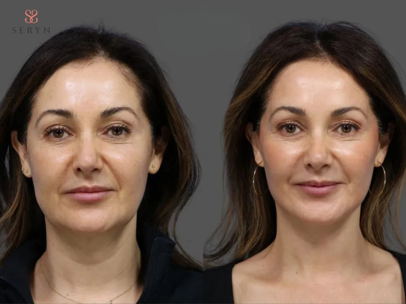 Facelift tác động sâu vào cấu trúc nâng đỡ để duy trì hiệu quả trong nhiều năm Facelift tác động sâu vào cấu trúc nâng đỡ để duy trì hiệu quả trong nhiều năm