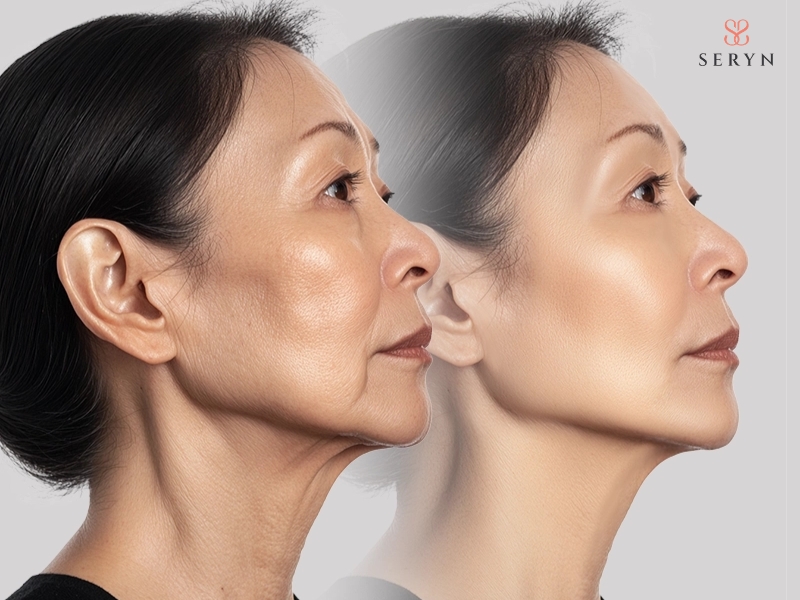 Nâng cơ mặt và căng da mặt tác động vào các lớp mô khác nhau để cải thiện dấu hiệu lão hóa Nâng cơ mặt và căng da mặt tác động vào các lớp mô khác nhau để cải thiện dấu hiệu lão hóa