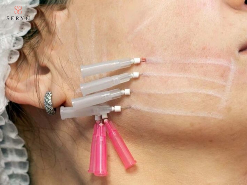 Bác sĩ đưa chỉ sinh học dưới da để tạo lực nâng đỡ mô chảy xệ Bác sĩ đưa chỉ sinh học dưới da để tạo lực nâng đỡ mô chảy xệ