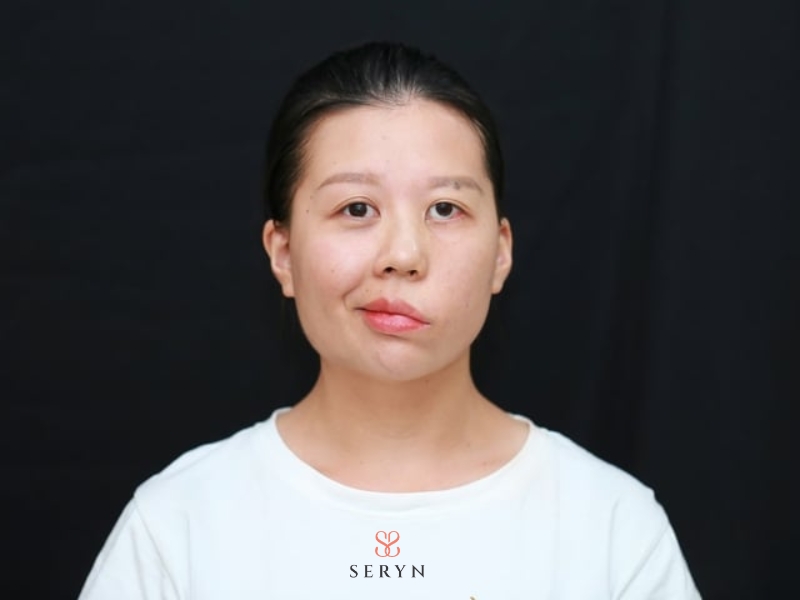 Một số biến chứng nặng có thể ảnh hưởng đến dây thần kinh, mô da Một số biến chứng nặng có thể ảnh hưởng đến dây thần kinh, mô da