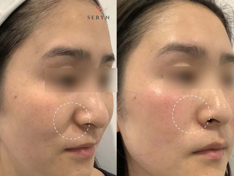 Da và cơ ổn định dần và kết quả cuối cùng trở nên rõ nét hơn theo thời gian Da và cơ ổn định dần và kết quả cuối cùng trở nên rõ nét hơn theo thời gian