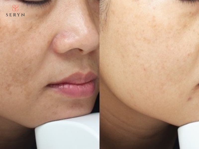 Hiệu quả IPL thể hiện qua cải thiện sắc tố và độ đều màu da Hiệu quả IPL thể hiện qua cải thiện sắc tố và độ đều màu da