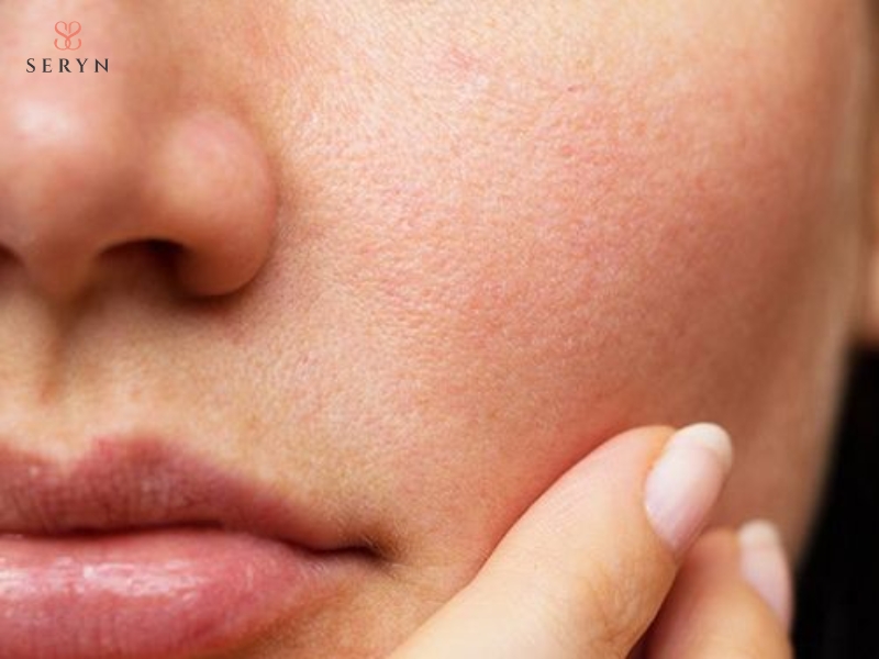 Da có thể đỏ nhẹ, sưng hoặc nóng rát thoáng qua sau khi chiếu IPL Da có thể đỏ nhẹ, sưng hoặc nóng rát thoáng qua sau khi chiếu IPL