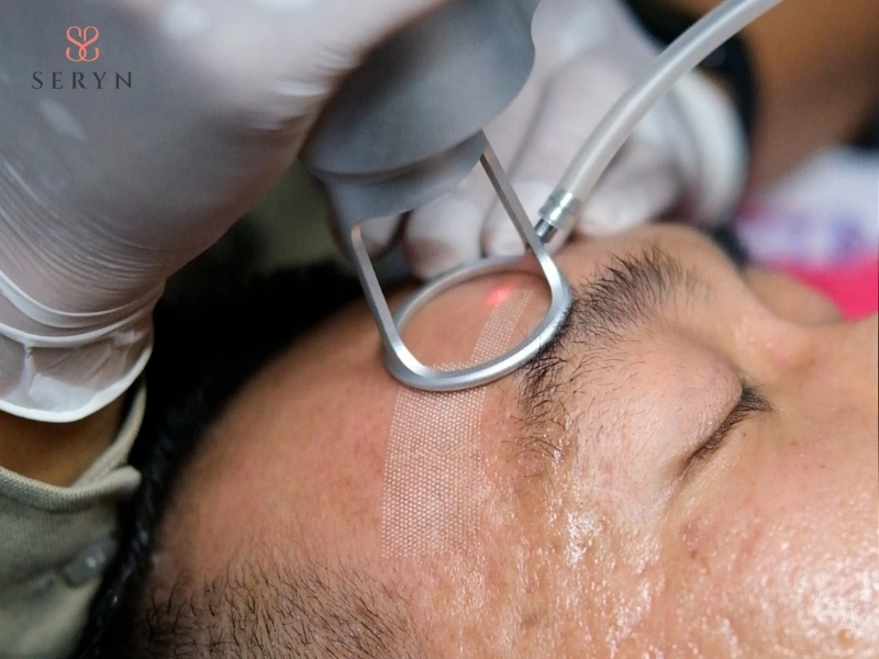 Laser vi điểm tạo các vùng tác động nhỏ trên da để kích thích collagen mà hạn chế tổn thương diện rộng Laser vi điểm tạo các vùng tác động nhỏ trên da để kích thích collagen mà hạn chế tổn thương diện rộng