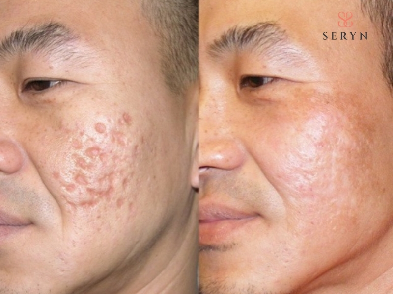 Laser có thể hỗ trợ cải thiện lỗ chân lông, sắc tố, sẹo mụn nông và độ đàn hồi của da Laser có thể hỗ trợ cải thiện lỗ chân lông, sắc tố, sẹo mụn nông và độ đàn hồi của da