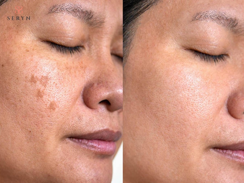Hiệu quả thực tế của lăn kim giữ được 6 tháng đến 1 năm sau liệu trình đầy đủ Hiệu quả thực tế của lăn kim giữ được 6 tháng đến 1 năm sau liệu trình đầy đủ