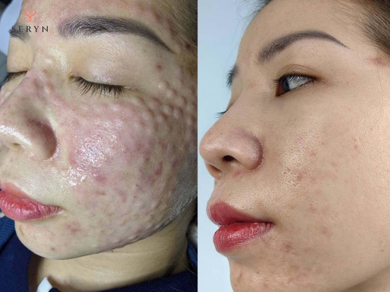 Meso có thể cải thiện độ ẩm và chất lượng da sớm Meso có thể cải thiện độ ẩm và chất lượng da sớm