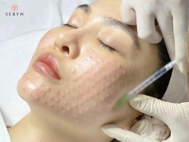 Meso sử dụng kim siêu nhỏ để đưa các dưỡng chất được lựa chọn trực tiếp vào vùng da cần điều trị Meso sử dụng kim siêu nhỏ để đưa các dưỡng chất được lựa chọn trực tiếp vào vùng da cần điều trị