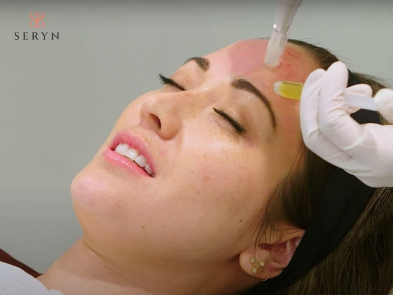Sưng đỏ nhẹ có thể xuất hiện sau khi tiêm PRP Sưng đỏ nhẹ có thể xuất hiện sau khi tiêm PRP