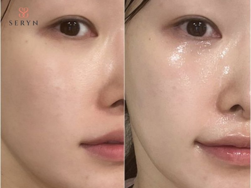 Hiệu quả PRP thường rõ hơn sau vài tuần Hiệu quả PRP thường rõ hơn sau vài tuần