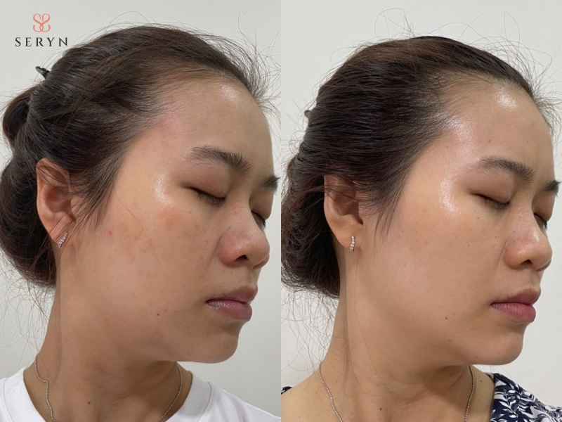 Phương pháp trẻ hoá da bằng PRP và tế bào gốc giữ được hiệu quả trong khoảng 6–12 tháng Phương pháp trẻ hoá da bằng PRP và tế bào gốc giữ được hiệu quả trong khoảng 6–12 tháng