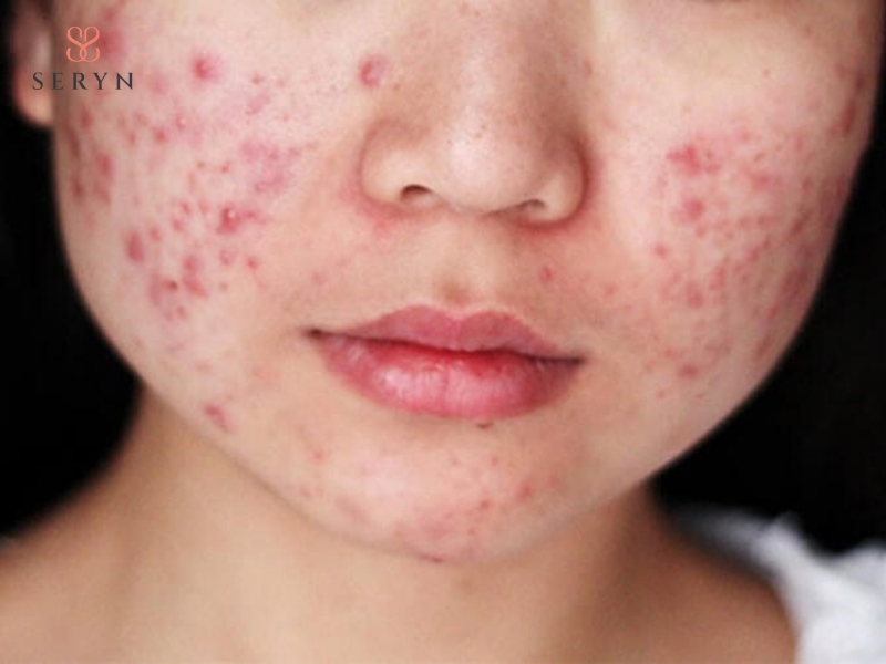 Người có da đang viêm nhiễm, mụn viêm nặng không nên trẻ hoá da bằng RF Người có da đang viêm nhiễm, mụn viêm nặng không nên trẻ hoá da bằng RF