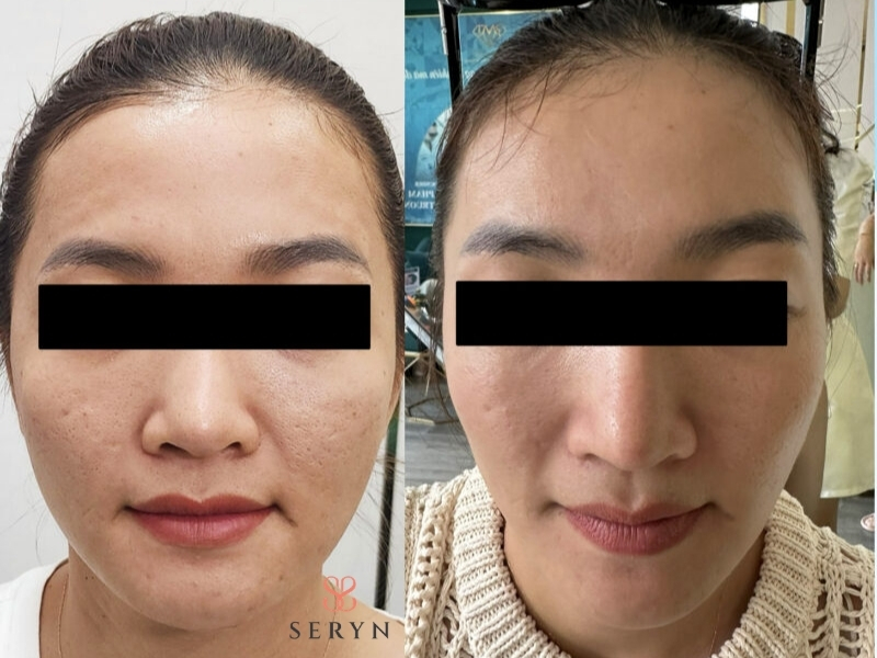RF phù hợp hơn với tình trạng lão hóa nhẹ đến trung bình và cần được lựa chọn theo tình trạng da RF phù hợp hơn với tình trạng lão hóa nhẹ đến trung bình và cần được lựa chọn theo tình trạng da