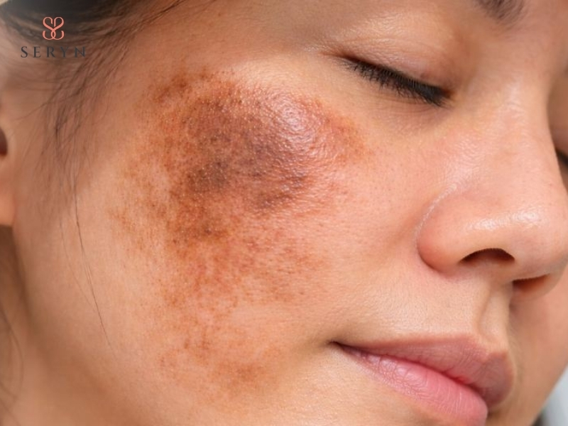 Trẻ hóa da bằng tế bào gốc nếu chăm sóc sau không đúng có thể tăng sắc tố sau viêm Trẻ hóa da bằng tế bào gốc nếu chăm sóc sau không đúng có thể tăng sắc tố sau viêm