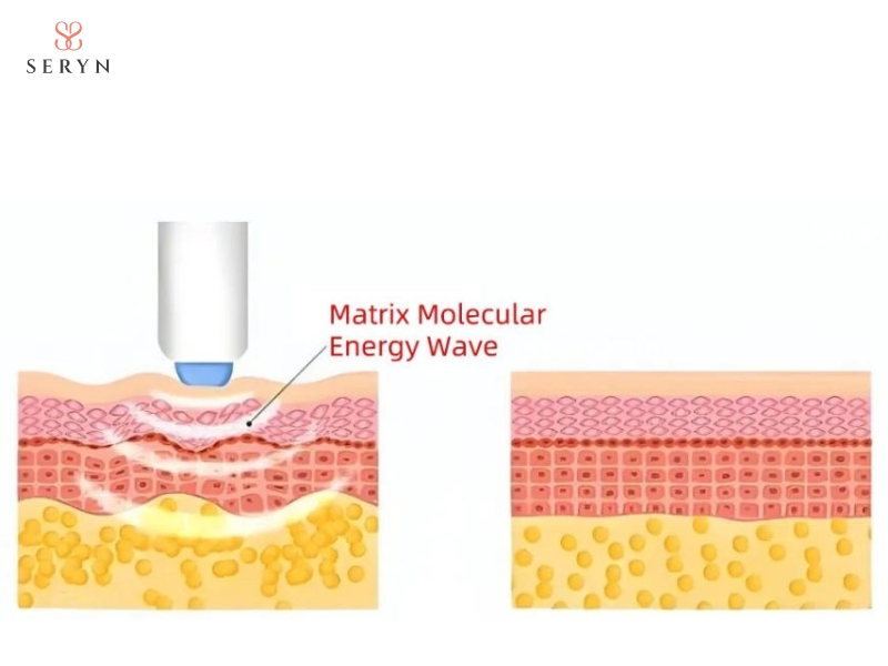 Thermage ứng dụng sóng RF đơn cực để tác động vào mô da, hỗ trợ cải thiện độ săn Thermage ứng dụng sóng RF đơn cực để tác động vào mô da, hỗ trợ cải thiện độ săn