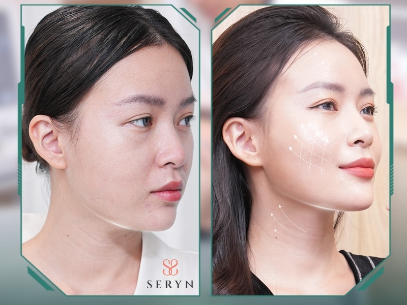 Ultherapy phù hợp với người bắt đầu có dấu hiệu da chùng nhẹ Ultherapy phù hợp với người bắt đầu có dấu hiệu da chùng nhẹ