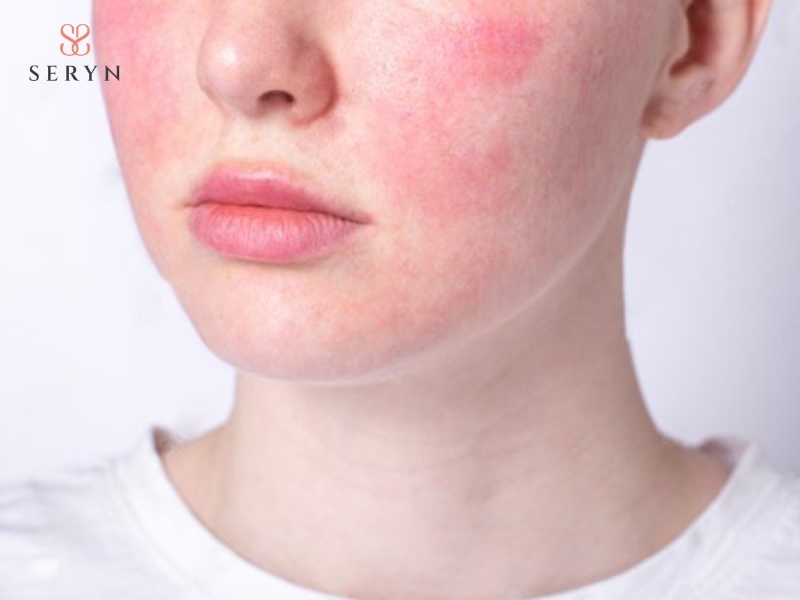 Ultherapy có thể gây đỏ hoặc sưng nhẹ tạm thời. Ultherapy có thể gây đỏ hoặc sưng nhẹ tạm thời.