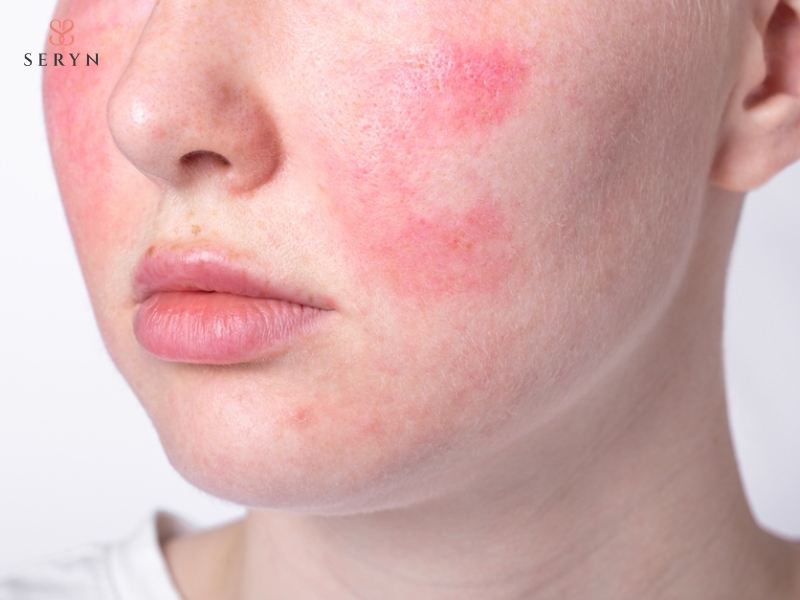 Da có thể đỏ, nóng rát hoặc sưng nhẹ sau một số phương pháp trẻ hóa Da có thể đỏ, nóng rát hoặc sưng nhẹ sau một số phương pháp trẻ hóa