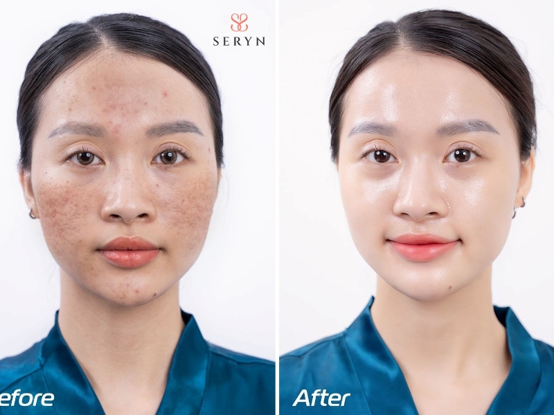 Đỏ và sưng nhẹ thường giảm dần trong thời gian ngắn sau 1-2 ngày điều trị Đỏ và sưng nhẹ thường giảm dần trong thời gian ngắn sau 1-2 ngày điều trị