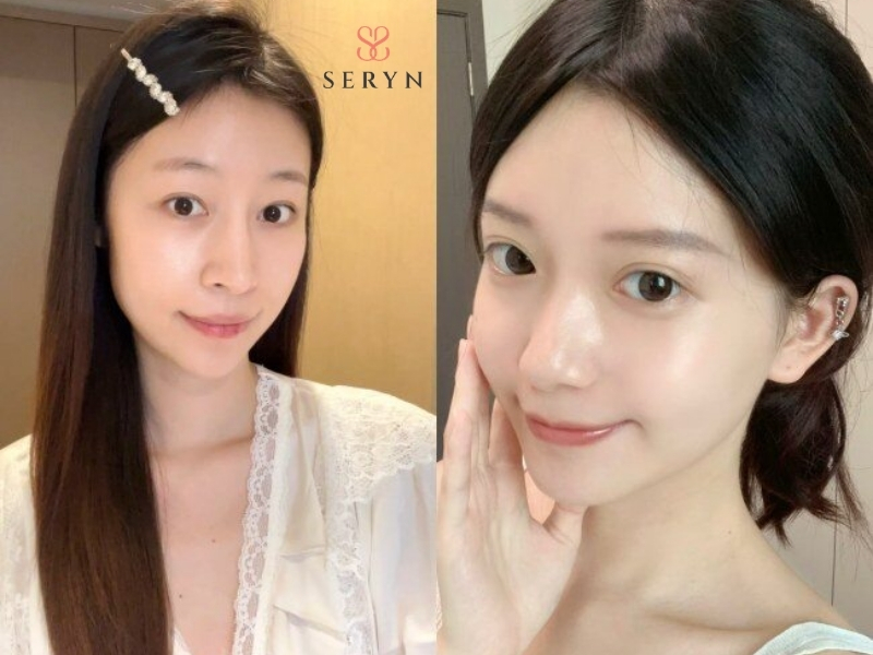 Trẻ hóa da tập trung cải thiện nếp nhăn, độ đàn hồi và tình trạng da chảy xệ Trẻ hóa da tập trung cải thiện nếp nhăn, độ đàn hồi và tình trạng da chảy xệ