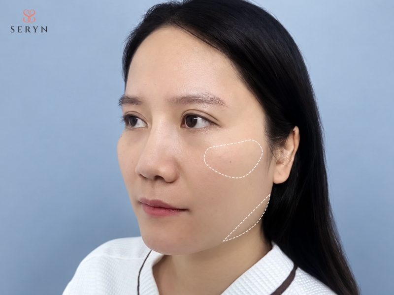 Vùng má lõm sâu, khiến xương gò má và đường viền xương hàm lộ rõ hơn Vùng má lõm sâu, khiến xương gò má và đường viền xương hàm lộ rõ hơn