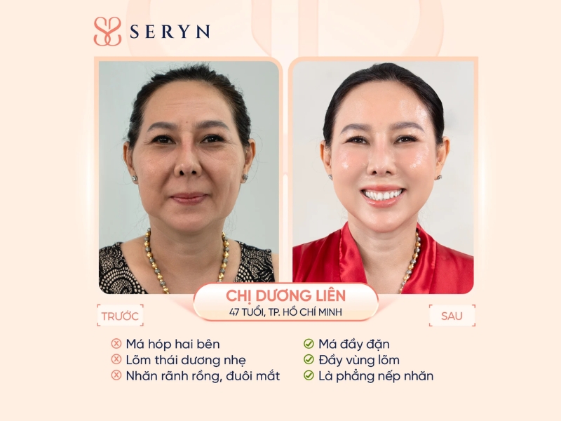 Can thiệp chuyên sâu tại clinic cải thiện má hóp trung bình đến nặng Can thiệp chuyên sâu tại clinic cải thiện má hóp trung bình đến nặng