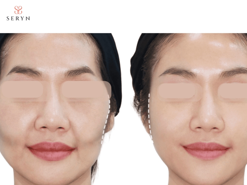 Má hóp xuất hiện khi thể tích mô mỡ vùng má suy giảm hoặc dịch chuyển Má hóp xuất hiện khi thể tích mô mỡ vùng má suy giảm hoặc dịch chuyển