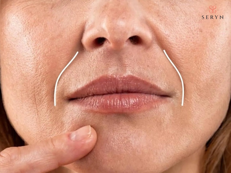 Rãnh cười là nếp gấp tự nhiên từ cánh mũi xuống khóe miệng Rãnh cười là nếp gấp tự nhiên từ cánh mũi xuống khóe miệng