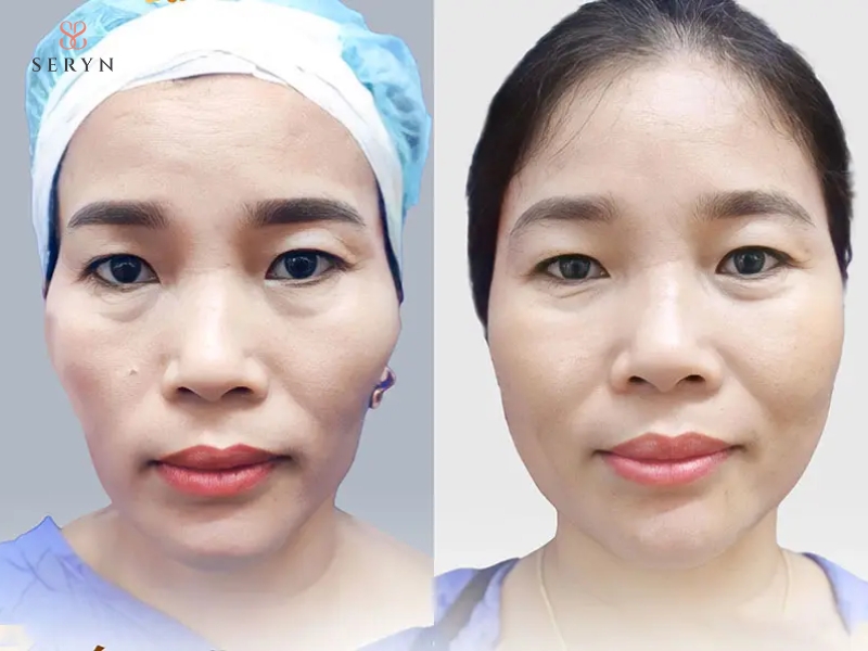 Kết quả cấy mỡ tự thân thường ổn định dần trong 2–3 tháng Kết quả cấy mỡ tự thân thường ổn định dần trong 2–3 tháng