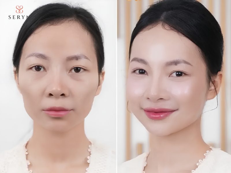 Người má hóp vừa đến nặng và có đủ mỡ dự trữ có thể cân nhắc phương pháp cấy mỡ tự thân Người má hóp vừa đến nặng và có đủ mỡ dự trữ có thể cân nhắc phương pháp cấy mỡ tự thân
