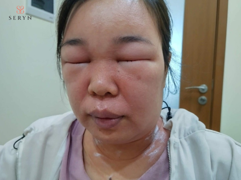 Cấy mỡ tự thân có thể gây sưng, bầm tím hoặc mất cân đối thể tích giữa hai bên má Cấy mỡ tự thân có thể gây sưng, bầm tím hoặc mất cân đối thể tích giữa hai bên má