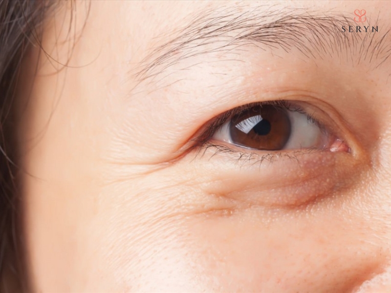 Da quanh mắt mỏng và ít tuyến bã nhờn nên dễ mất ẩm, kém đàn hồi và hình thành nếp nhăn Da quanh mắt mỏng và ít tuyến bã nhờn nên dễ mất ẩm, kém đàn hồi và hình thành nếp nhăn