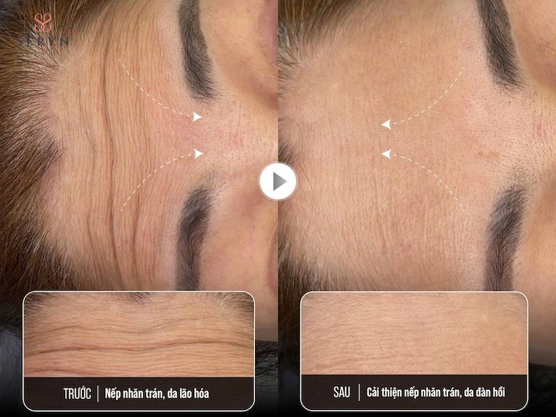Filler HA làm đầy các rãnh nhăn tĩnh trên vùng trán Filler HA làm đầy các rãnh nhăn tĩnh trên vùng trán