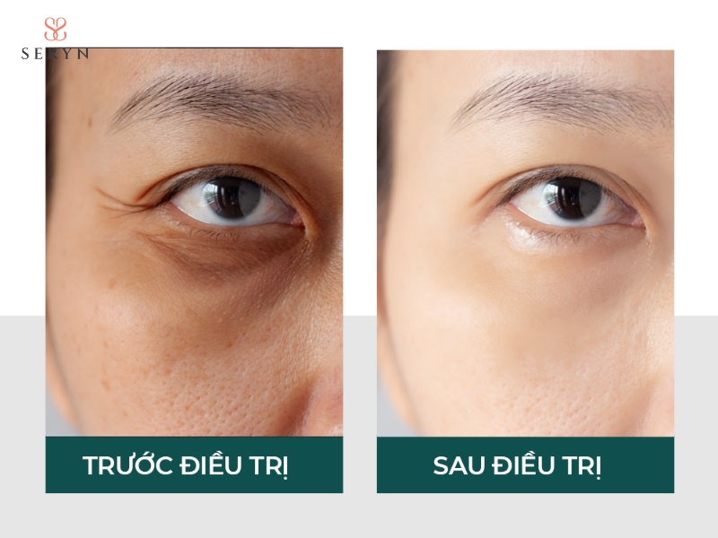Hiệu quả laser thường rõ dần sau vài tuần và có thể duy trì trong nhiều tháng tùy cơ địa Hiệu quả laser thường rõ dần sau vài tuần và có thể duy trì trong nhiều tháng tùy cơ địa