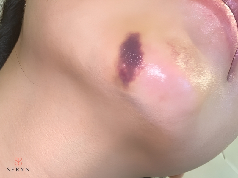 Tiêm Botox bị sưng kéo dài có thể là dấu hiệu cần được kiểm tra Tiêm Botox bị sưng kéo dài có thể là dấu hiệu cần được kiểm tra
