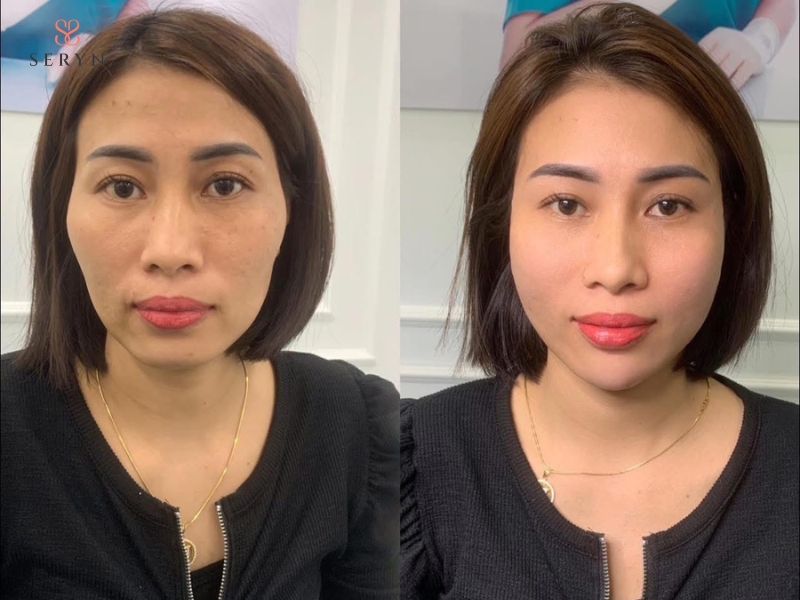 Vùng má dần ổn định khi tình trạng sưng giảm và filler thích nghi với mô xung quanh Vùng má dần ổn định khi tình trạng sưng giảm và filler thích nghi với mô xung quanh