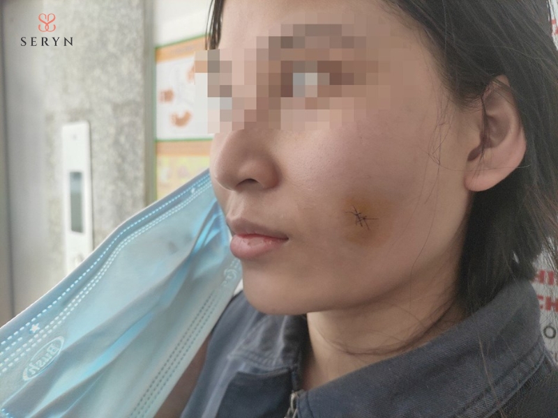 Người đang có nhiễm trùng tại vùng tiêm cần được điều trị trước khi thực hiện Người đang có nhiễm trùng tại vùng tiêm cần được điều trị trước khi thực hiện